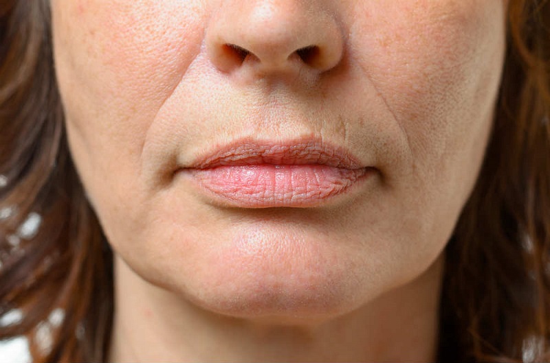 Как убрать глубокие морщины вокруг рта: 5 домашних масок, творящих чудеса с увядающей кожей