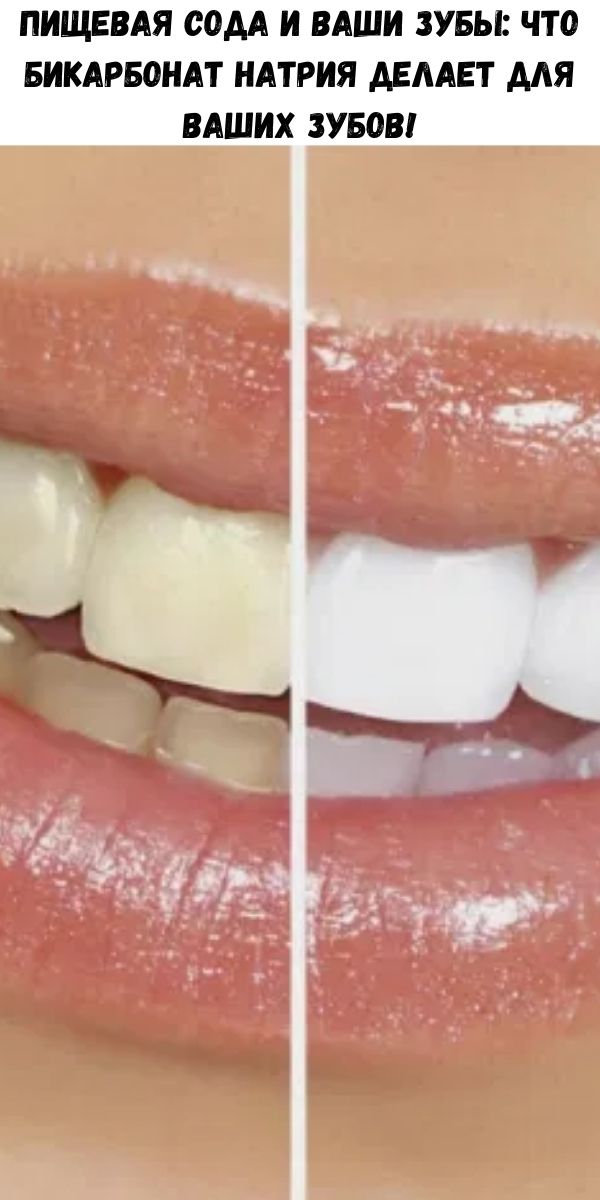 Пищевая сода и ваши зубы: что бикарбонат натрия делает для ваших зубов!