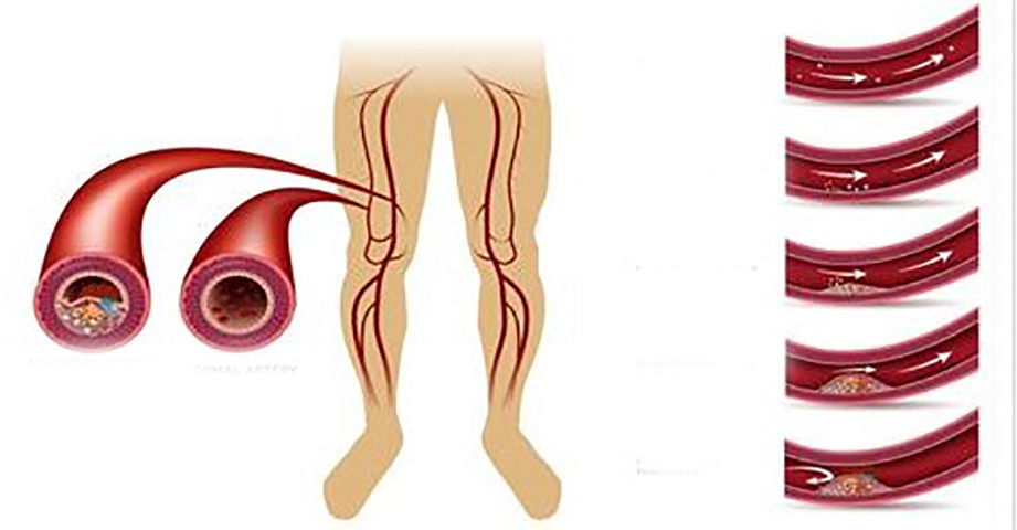Атеросклероз сосудов нижних конечностей картинки