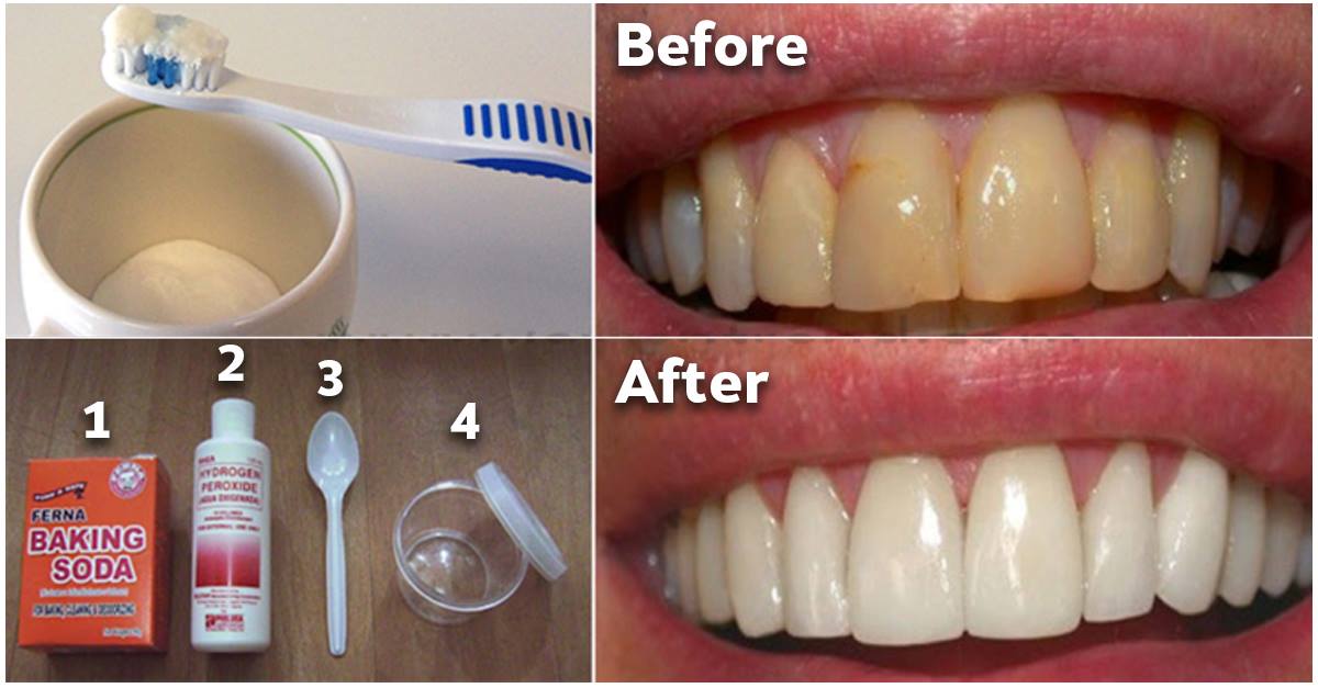 Как избавиться от зубного налета и отбеливать зубы без дорогостоящих процедур