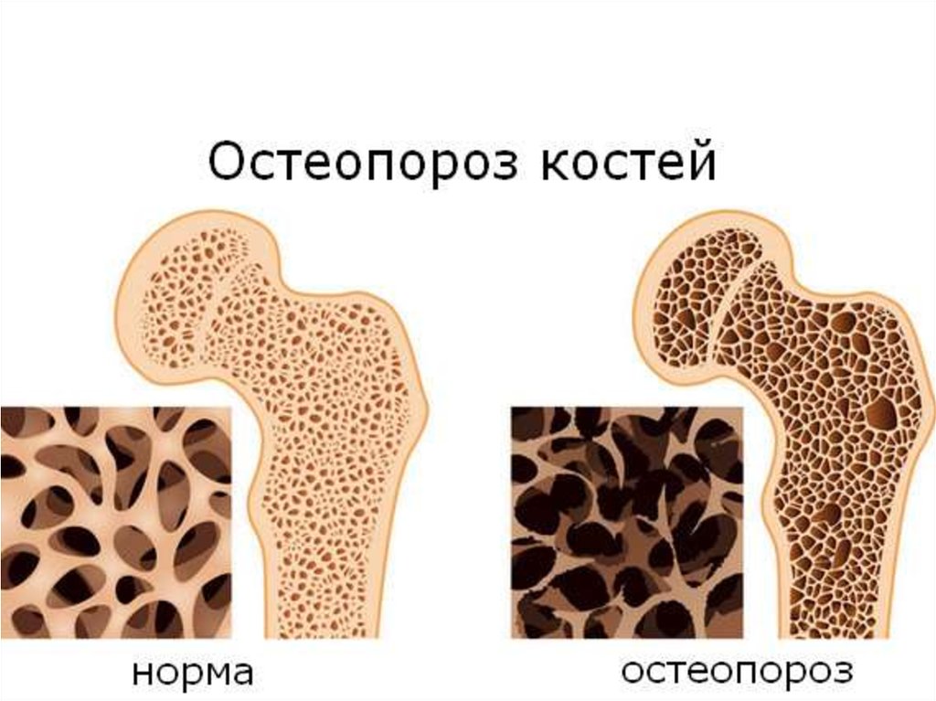 8 простых растяжек при остеопорозе, которые исцеляют хрупкий костный мозг