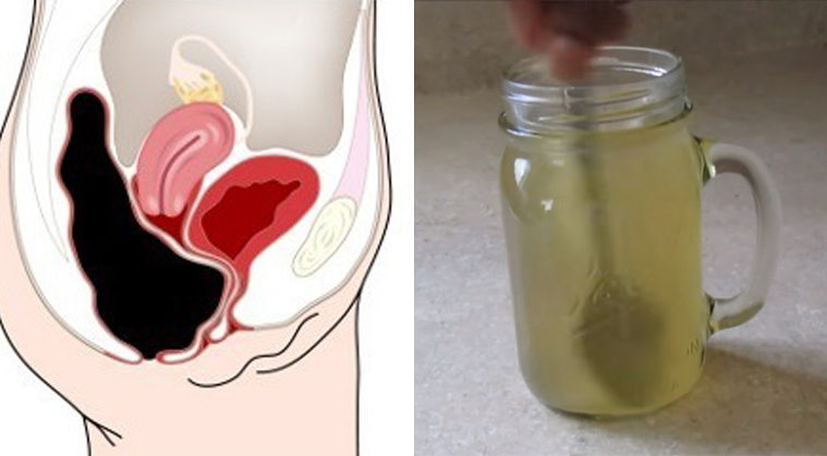 Очистите свой организм и избавьтесь от запора с яблочным уксусом и медом!